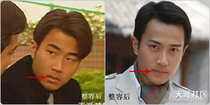 整容部位六：下顎(磨腮)