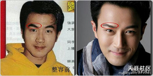 毛毛蟲眉毛通過激光脫毛手術變疏密恰當精致的劍眉整容部位：眉毛