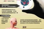 h7n9診療方案 衛計委公