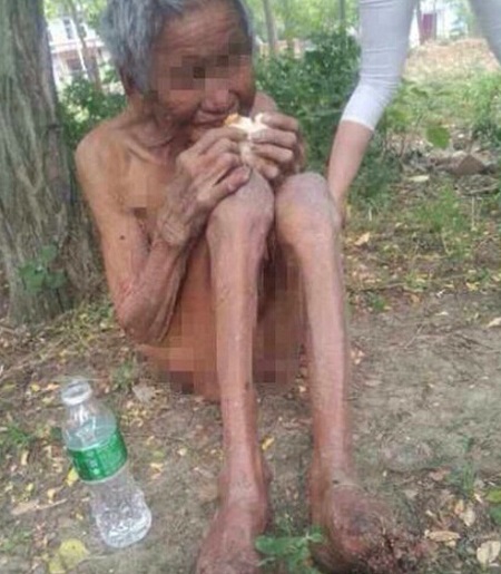 9旬老太雙目失眠 無人照顧腳上長蛆