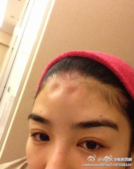 黃奕家暴是假的 額頭凹進去是用手指按的