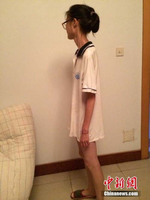 女孩過度節食導致閉經