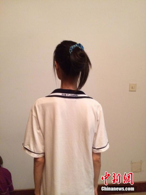 女孩過度節食導致閉經