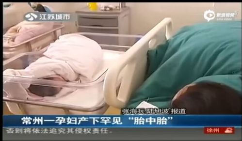 孕婦產(chǎn)下胎中胎