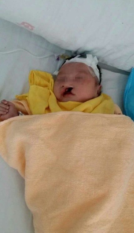 兔唇男嬰被棄荒野