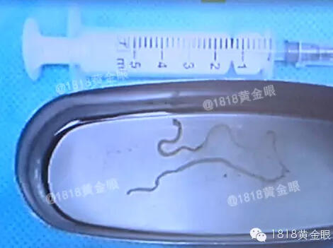 曼氏裂頭蚴寄生蟲鉆入大腦：嘉興12歲女孩腦中取出20厘米寄生蟲