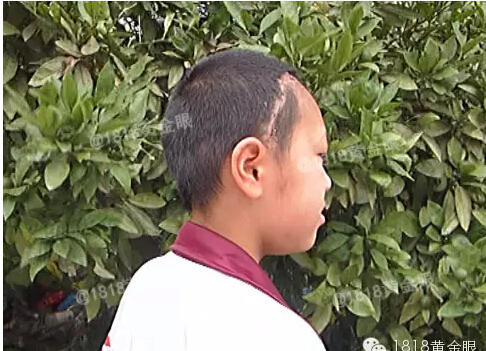 曼氏裂頭蚴寄生蟲鉆入大腦：嘉興12歲女孩腦中取出20厘米寄生蟲