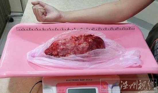 醫生為巨蟒切腫瘤