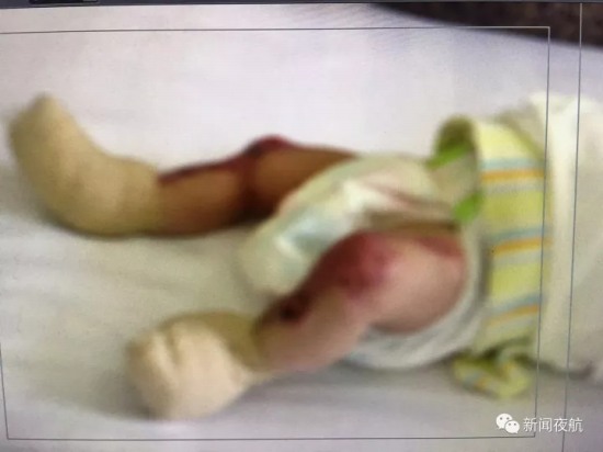 女嬰先天皮膚缺失