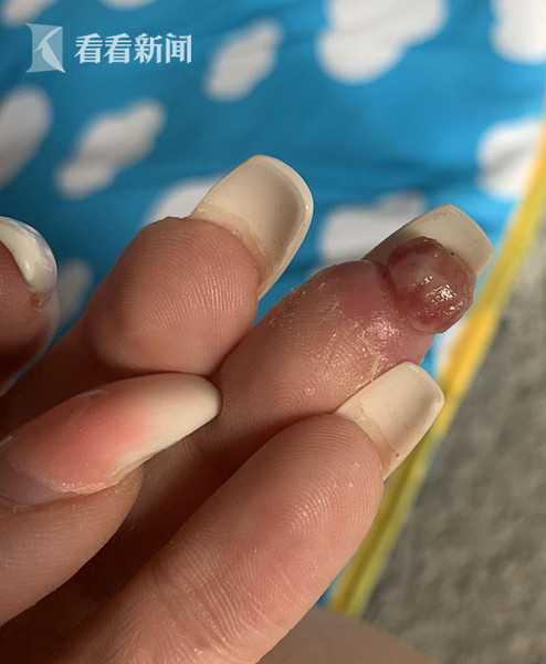 孕婦做美甲遭感染