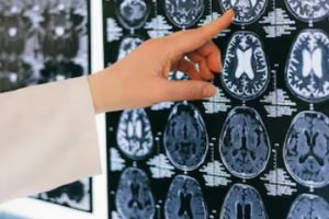 到2023年中國慢性腎病